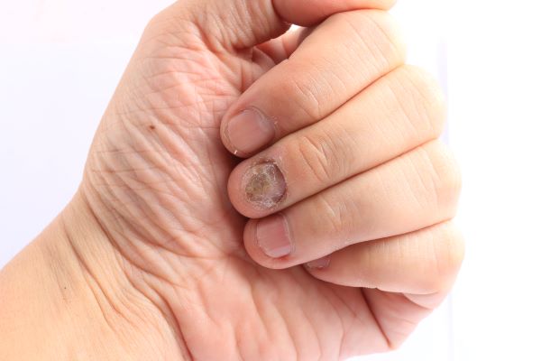 Grzybica dłoni przyczyny objawy i leczenie Jak wygląda grzybica